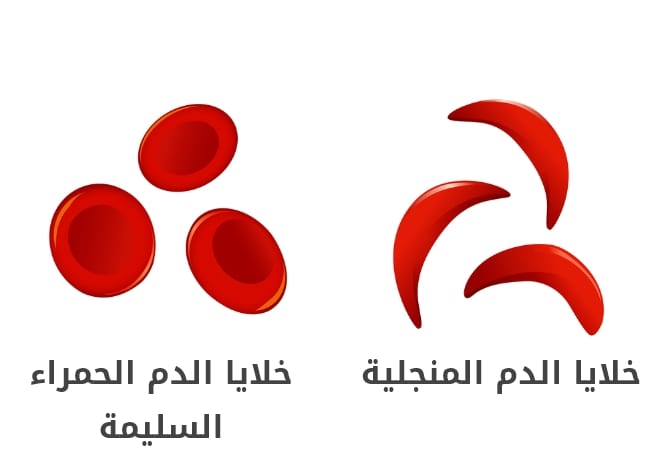 مرض فقر الدم المنجلي
