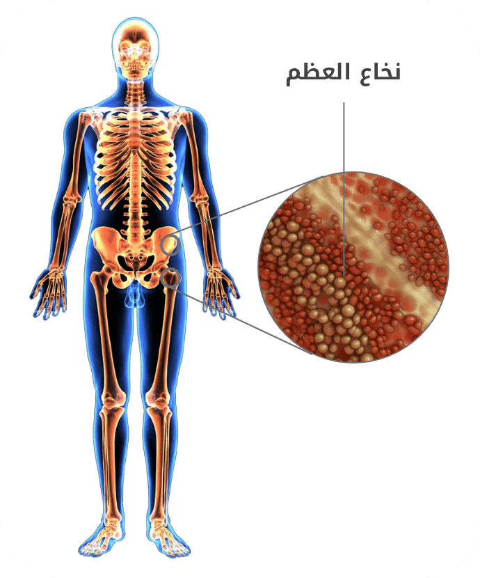 زراعة الخلايا الجذعية ونخاع العظام