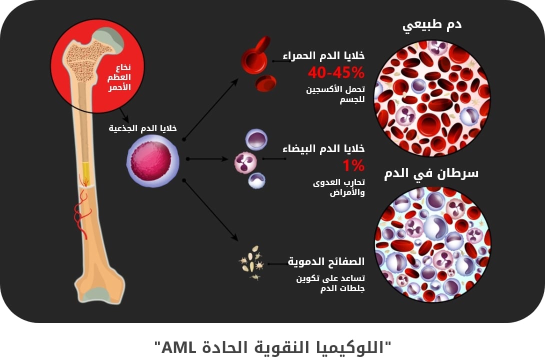 اللوكيميا النقوية الحادة AML